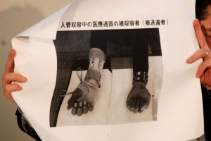 入管収容時に右手を怪我。適切な治療なく指が曲がらなくなった男性の写真。（撮影／西中誠一郎）